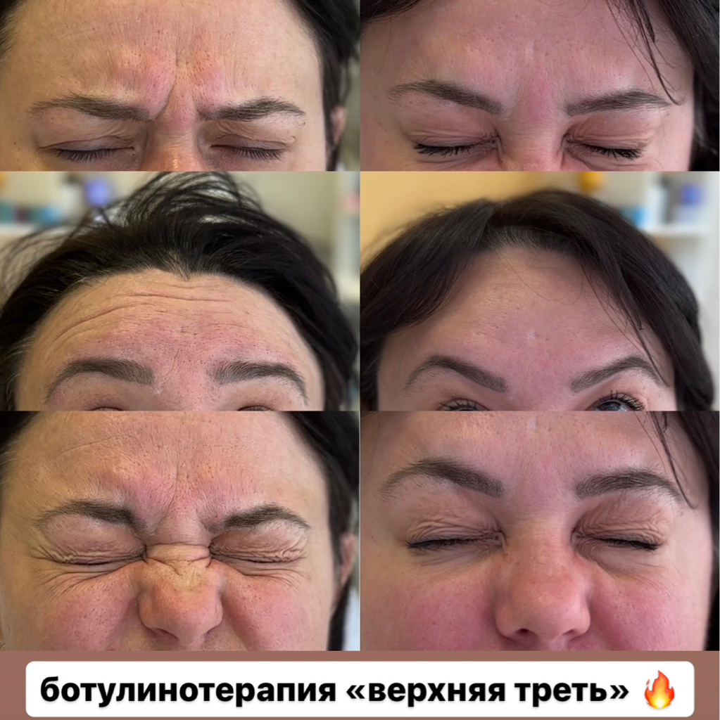 ХИТ ❗️Верхняя треть лица (пять зон)