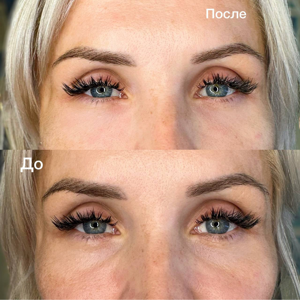 ХИТ ❗️От морщин вокруг глаз Biogel PDRN или Refaltis eyes