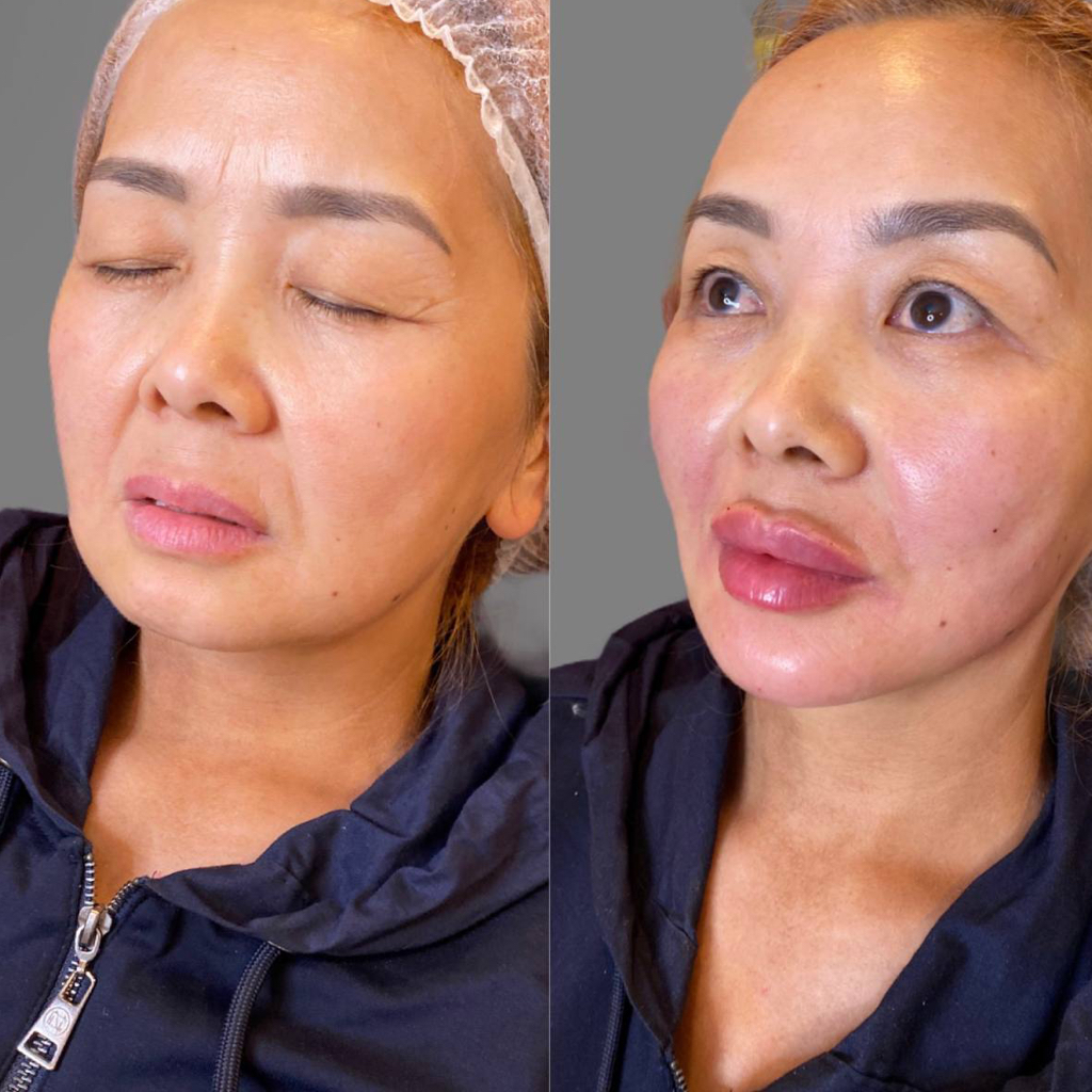 Full Face Filler — скулы + углы нижней челюсти + подбородок + губы