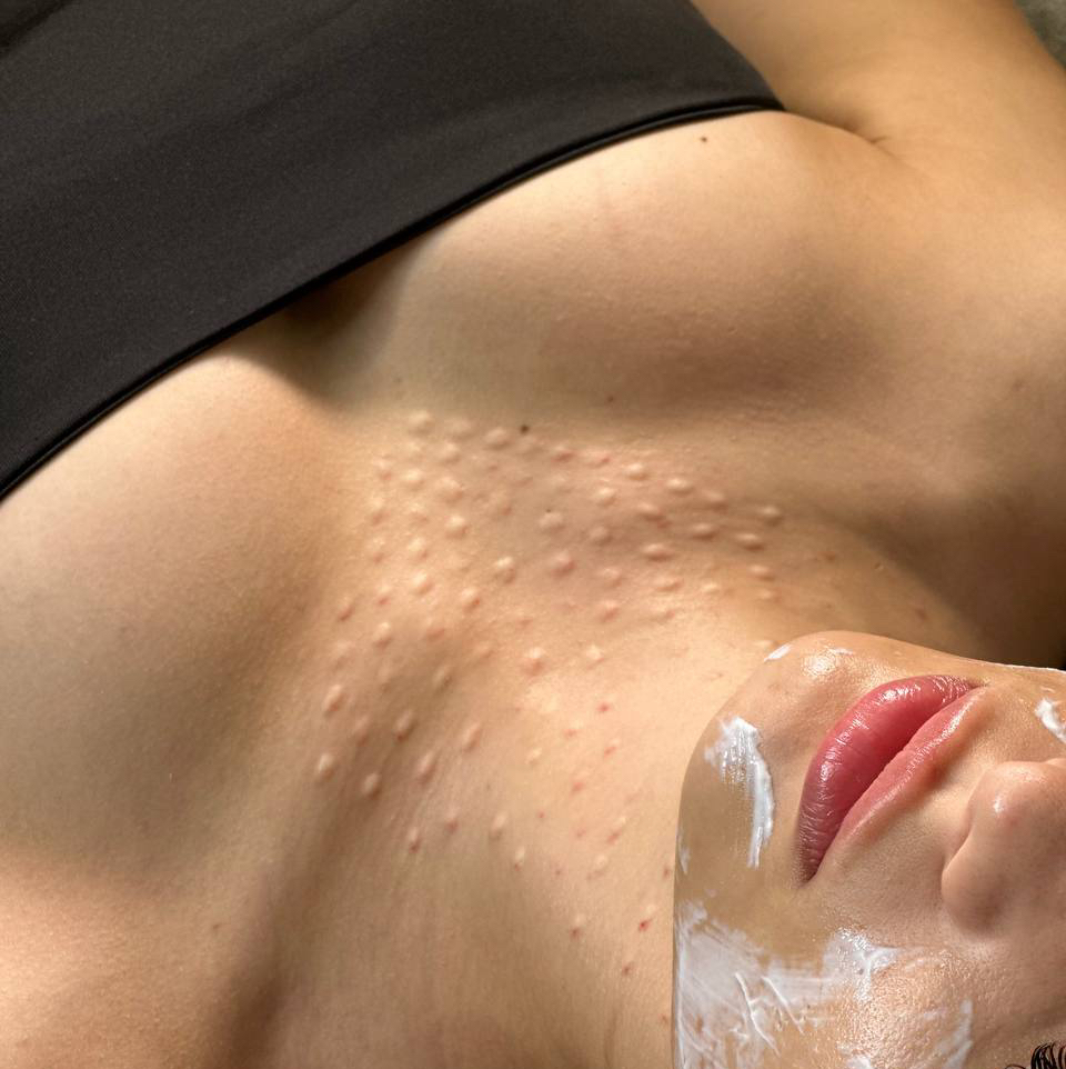 Биоревитализация (Biogel, Refaltis)