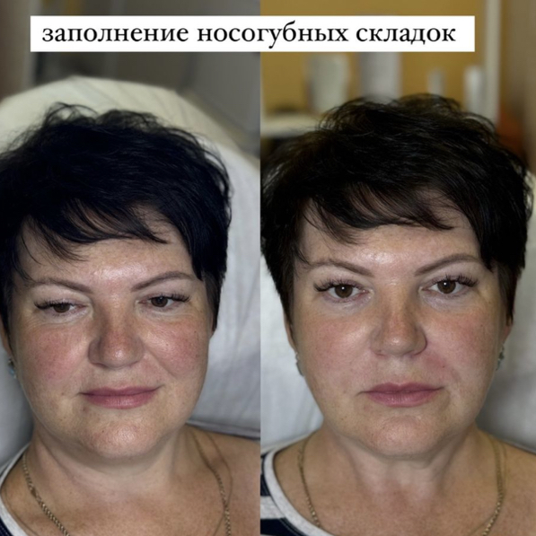 ХИТ ❗️Заполнение носогубок