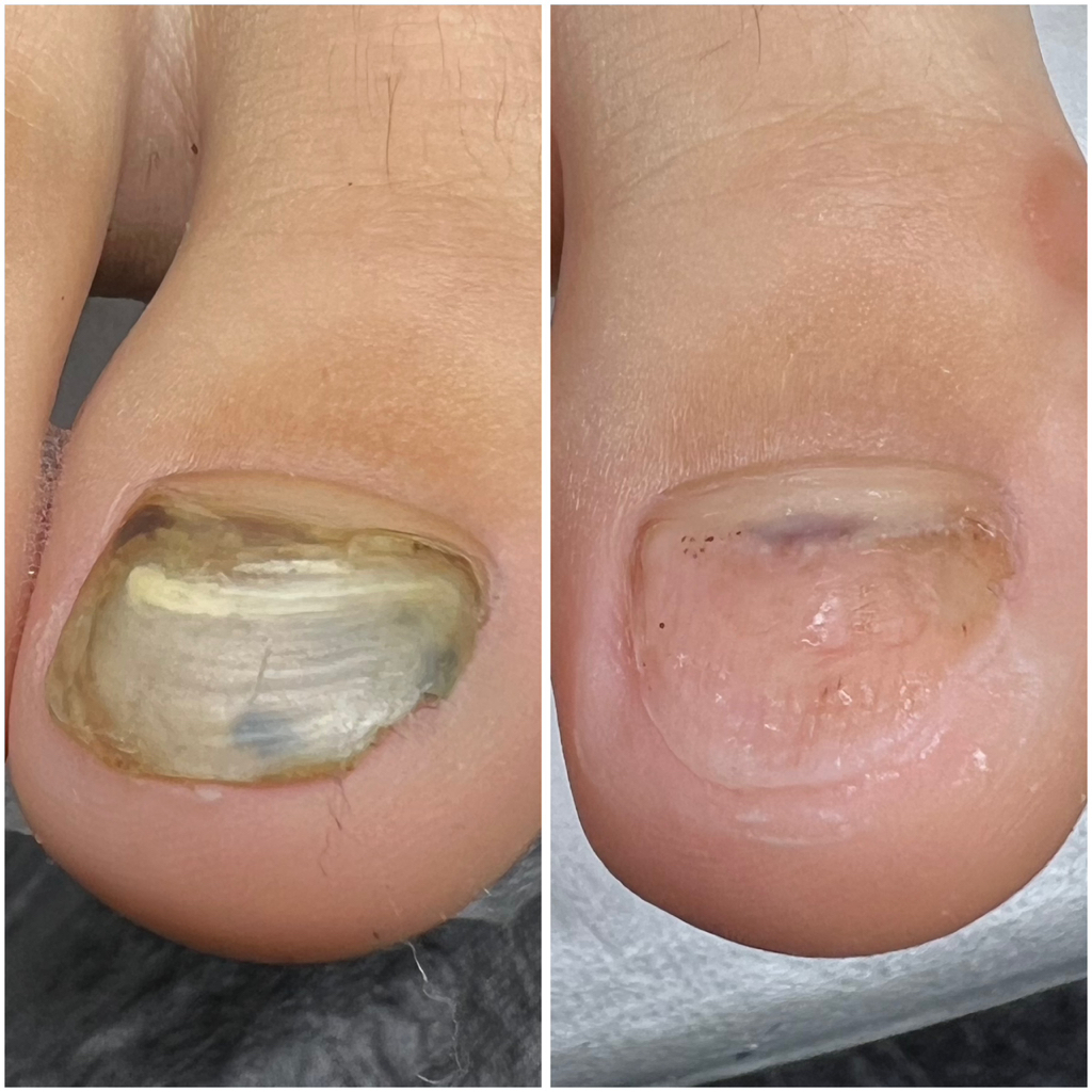 Обработка онихолизис . Большой пальчик