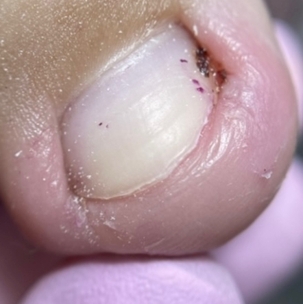 Обработка вросшего ногтя без воспаления