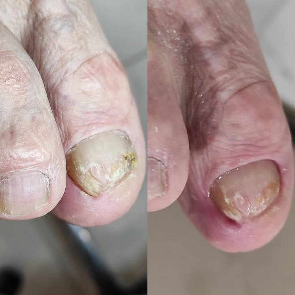 Зачистка пораженных ногтей (9-10 ед )