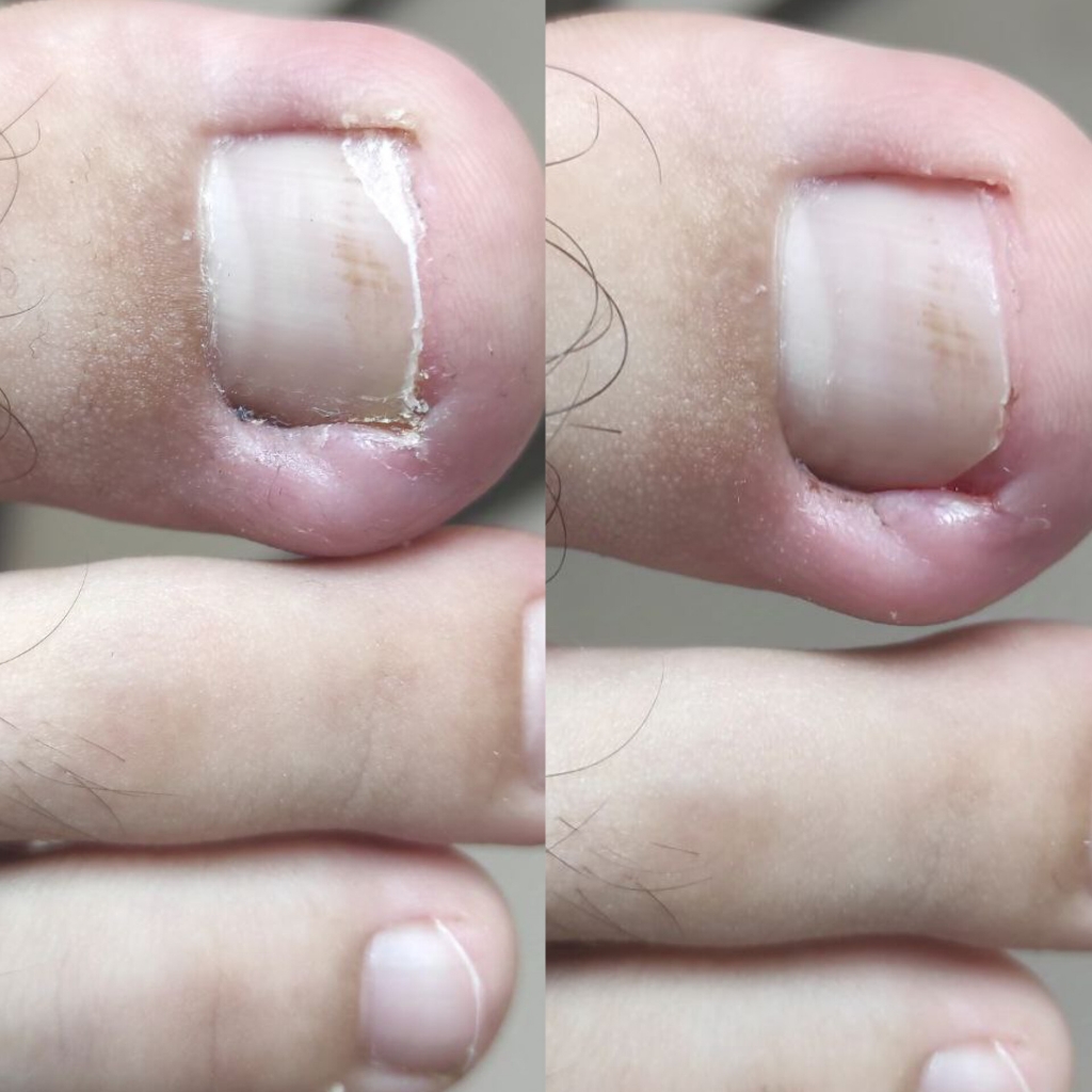 Обработка вросшего ногтя без воспаления