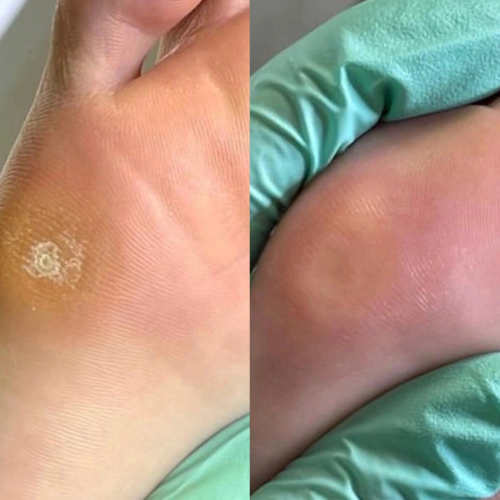 Обработка от 4-х до 6-ти проблемных зон