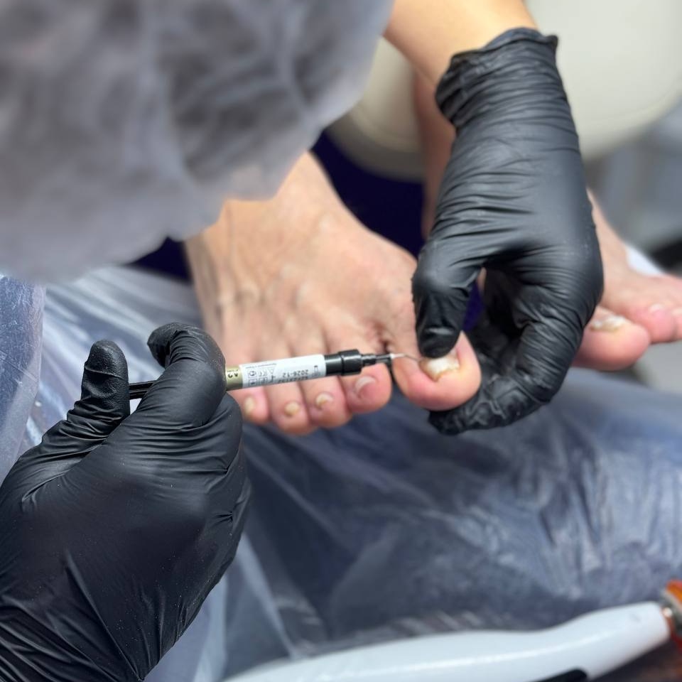 Обработка ногтя + установка титановой нити (первичная установка)