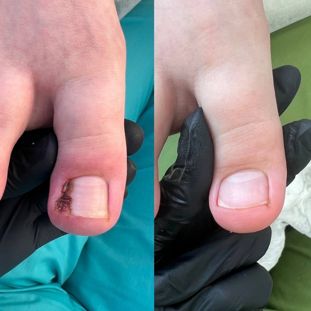 Обработка вросшего ногтя с воспалением