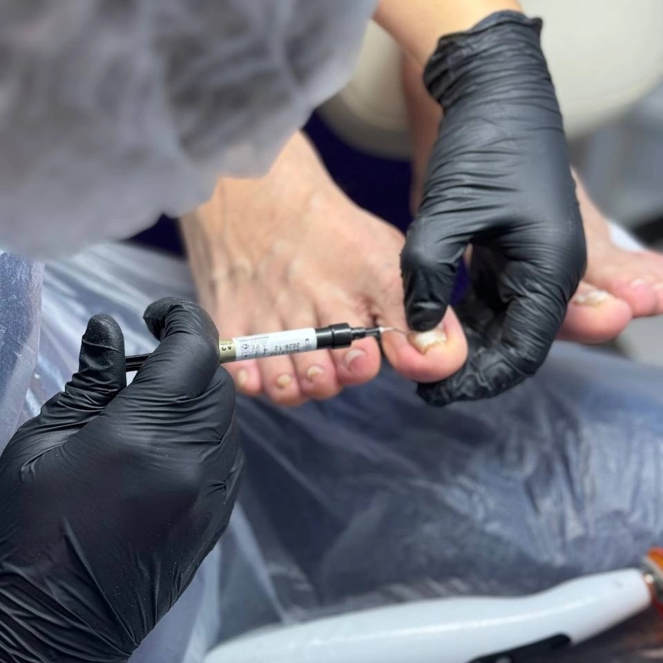 Обработка ногтя + коррекция титановой нити (повторная установка)