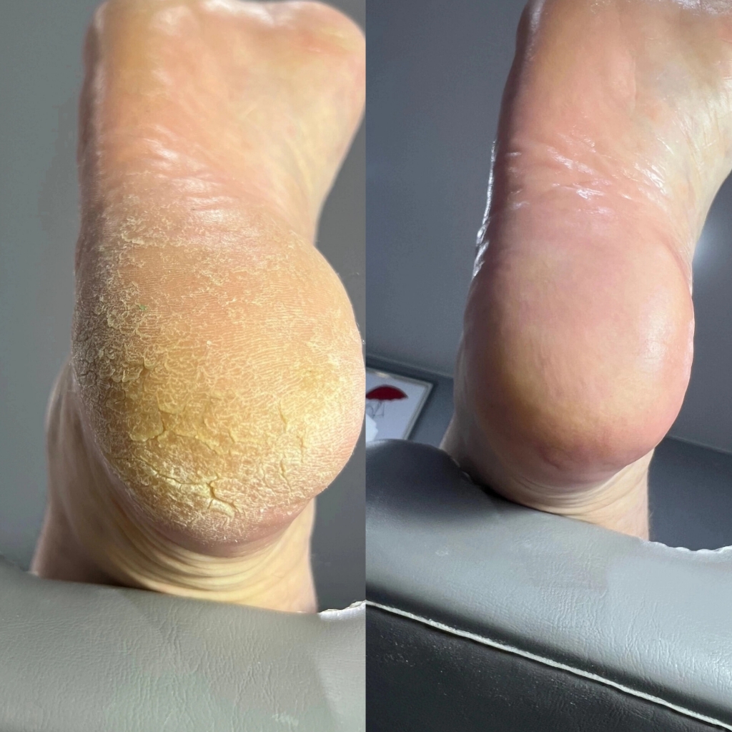 Подологический педикюр 2 категория