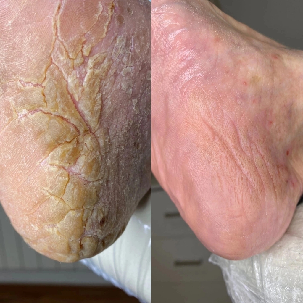 Подологический педикюр 3 категория