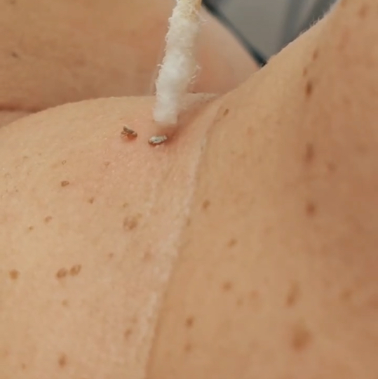 Удаление новообразований