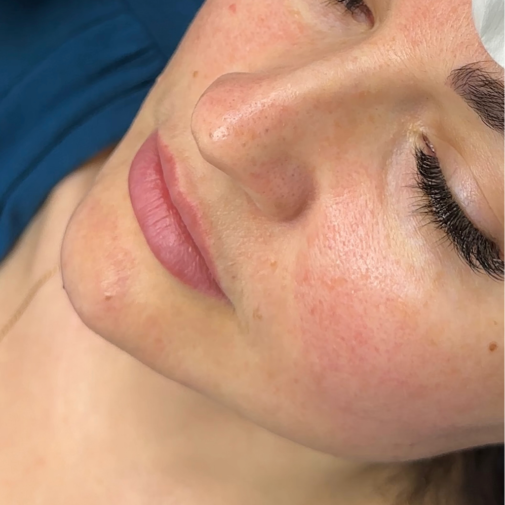 Контурная пластика подбородка