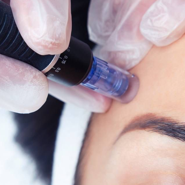 Фракционная мезотерапия (лицо)