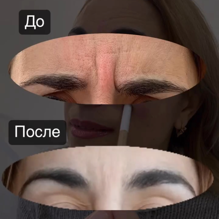 Нет морщинкам (межбровье)