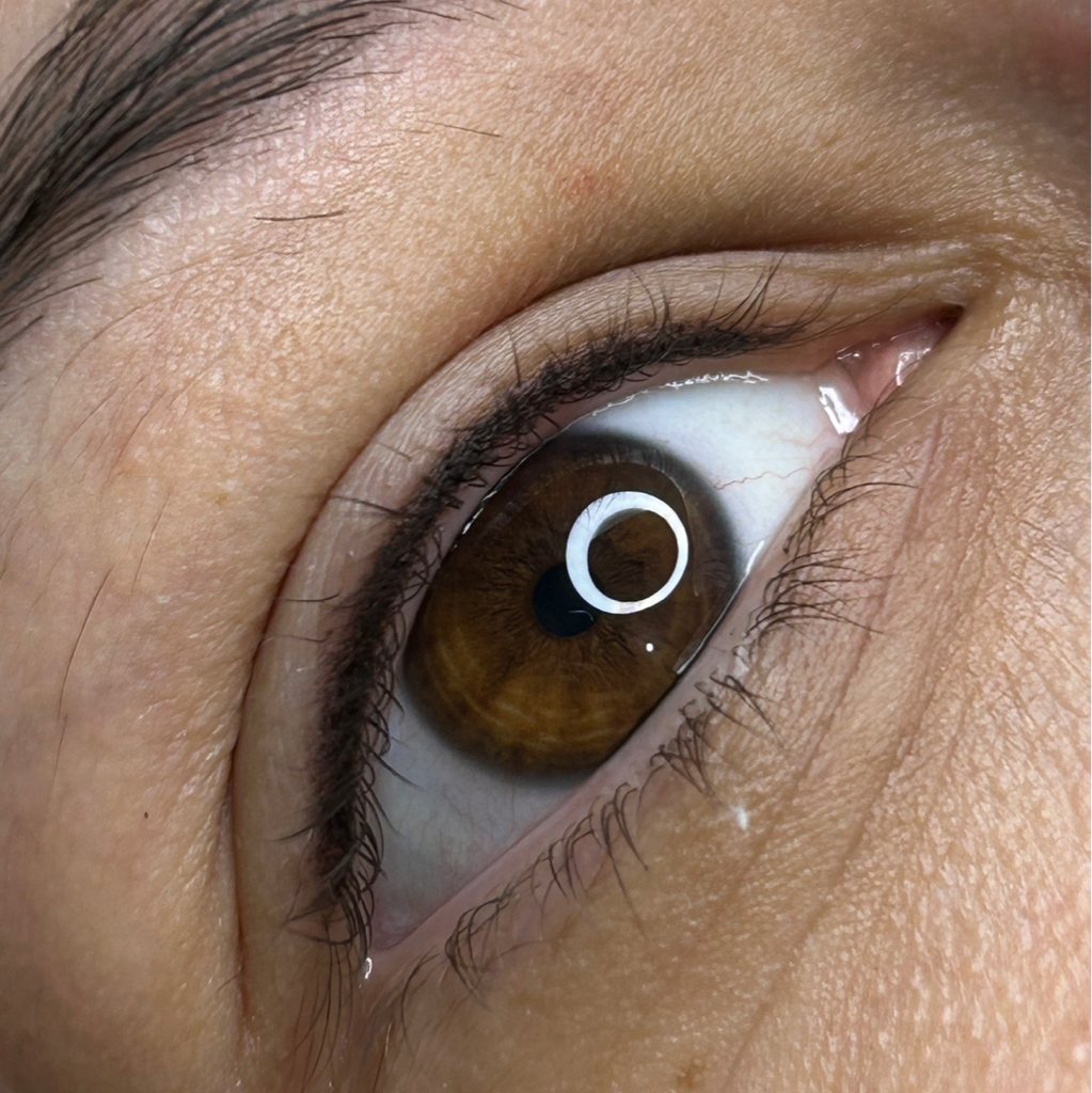 Веки - Межресничка(первично)