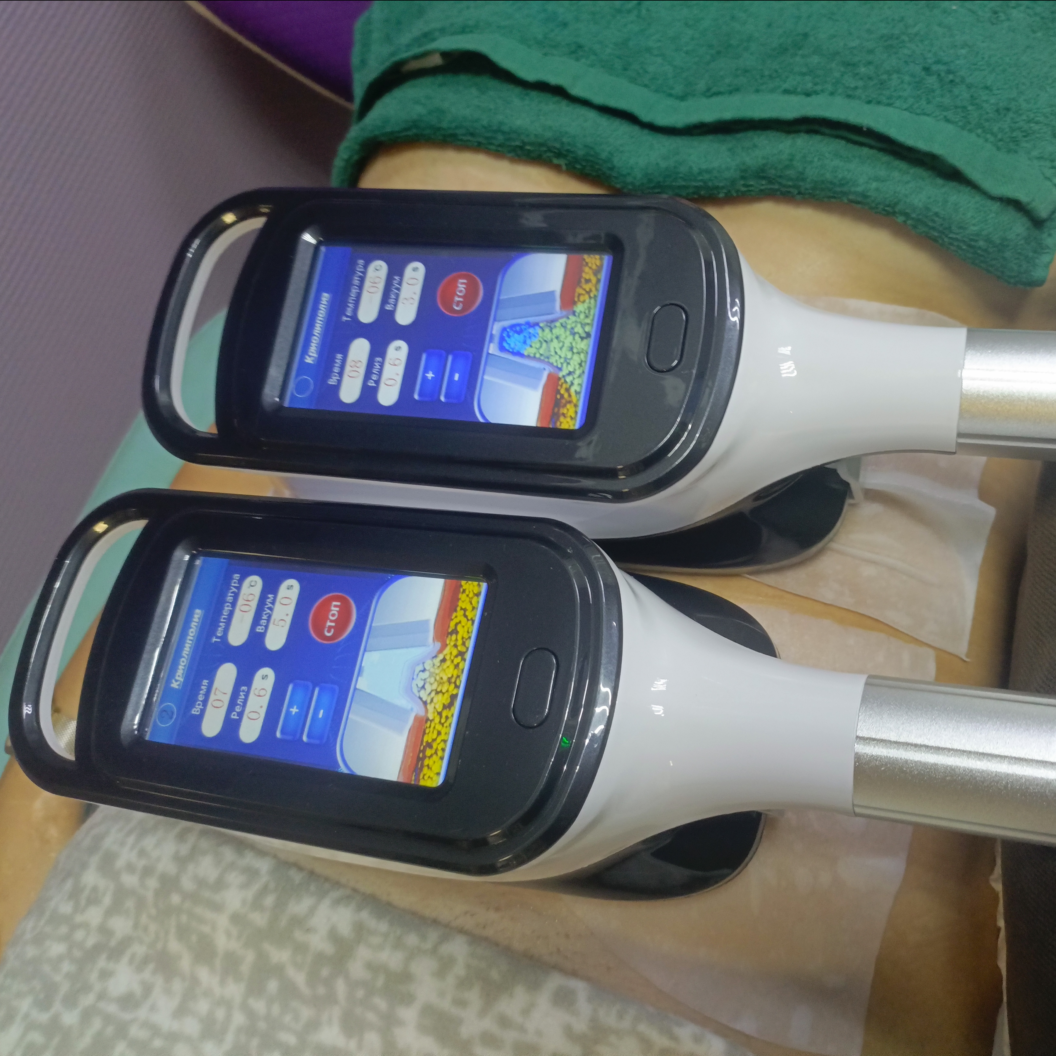 Криолиполиз (2 зоны)