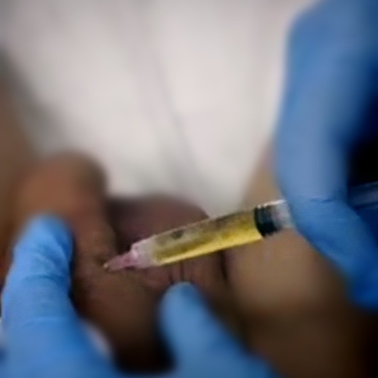 PRP-ТЕРАПИЯ для Мужчин