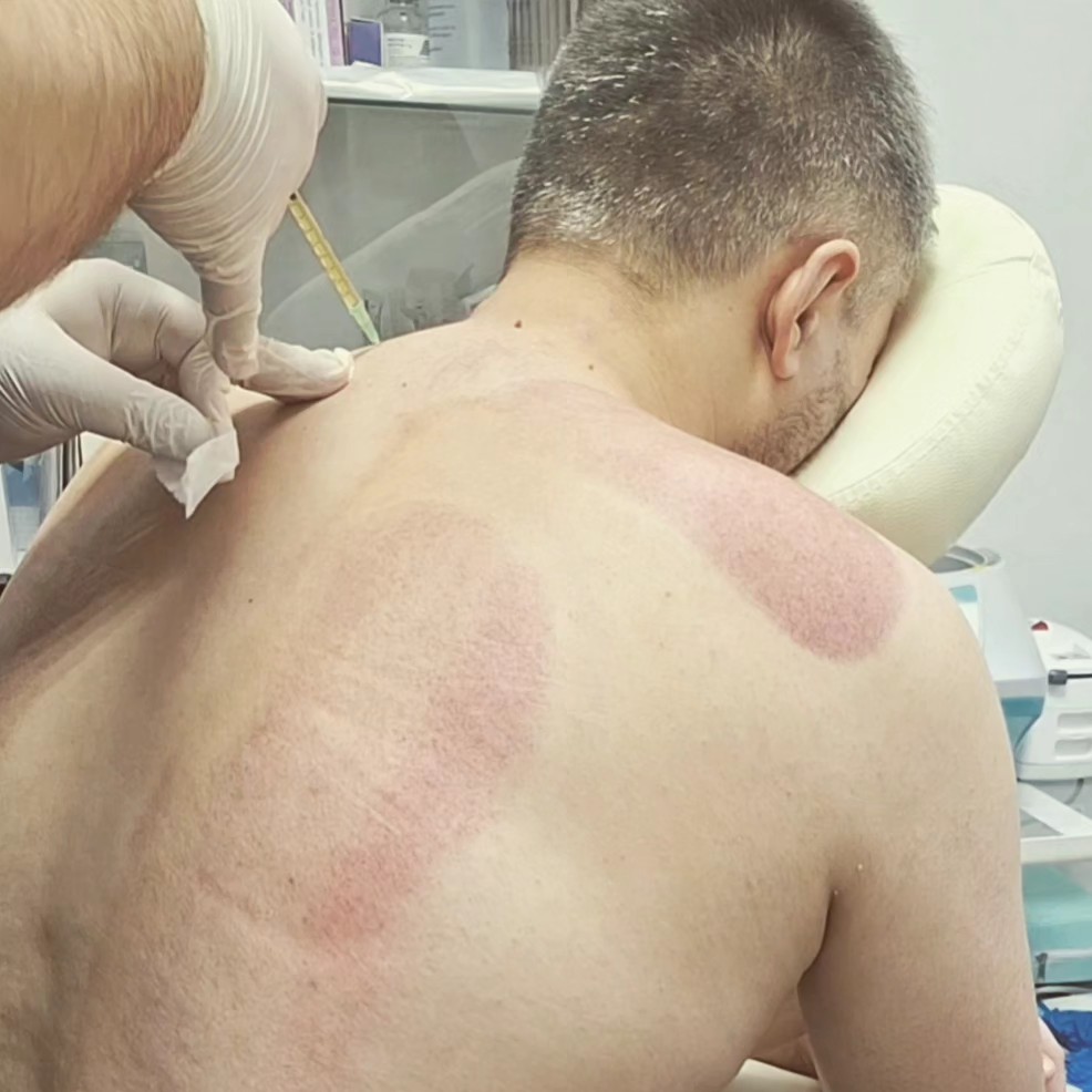 PRP-ТЕРАПИЯ при межпозвоночных грыжах