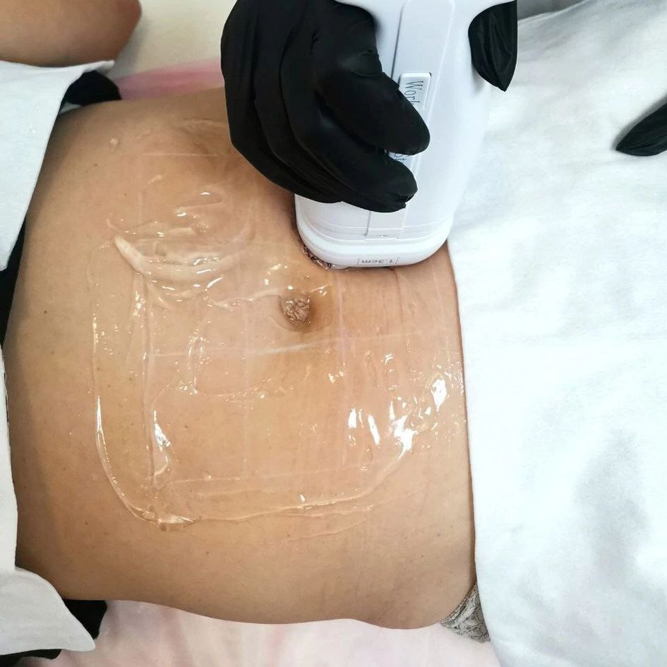 Липосоникс