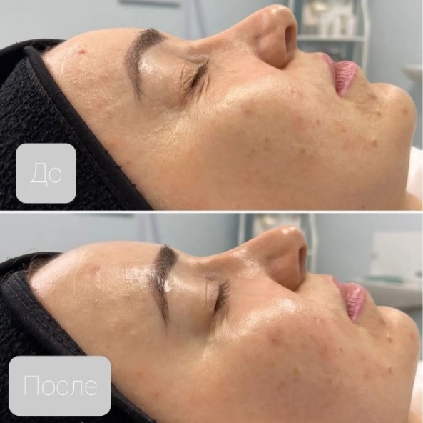 3D-уход  за лицом(массаж+мышечная маска+сыворотка Cleopain)