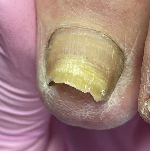 Обработка одного ногтя  (Онихомикоз)