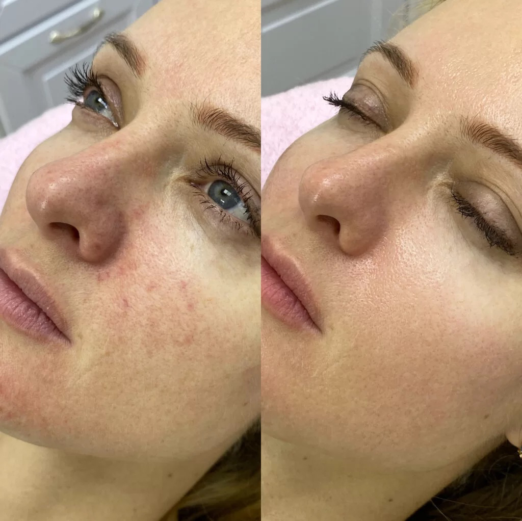 Фотоомоложение лица