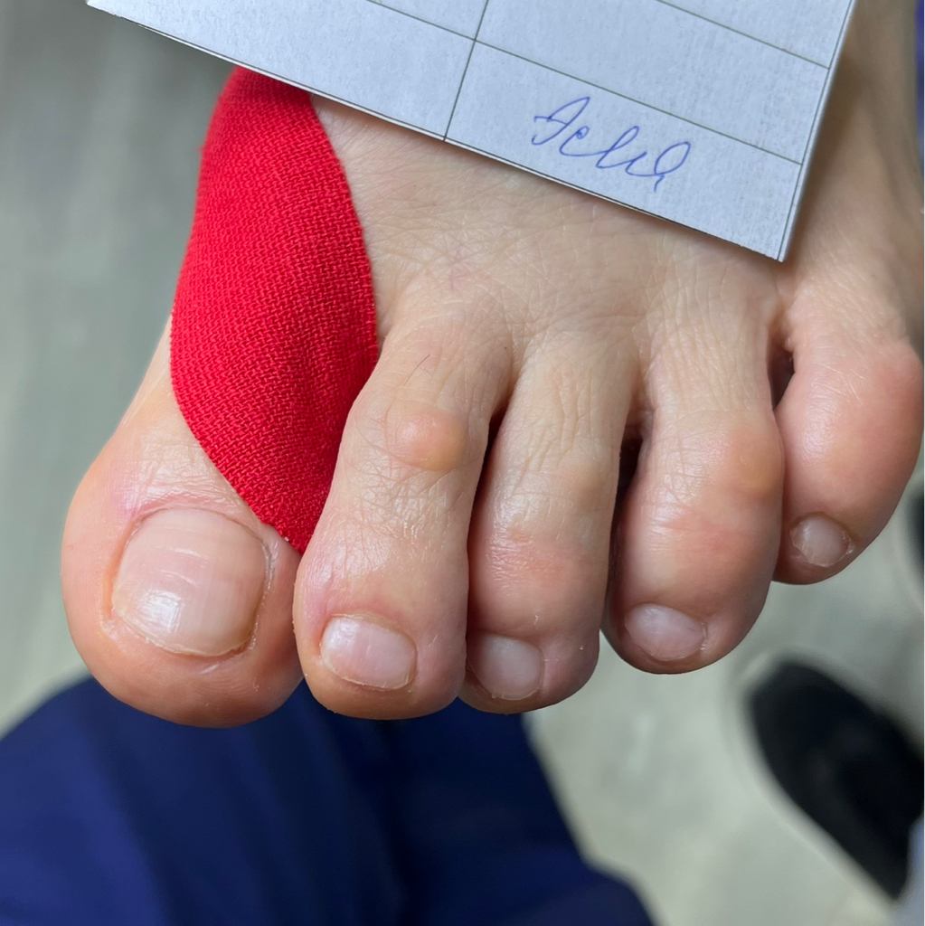 Тейпирование