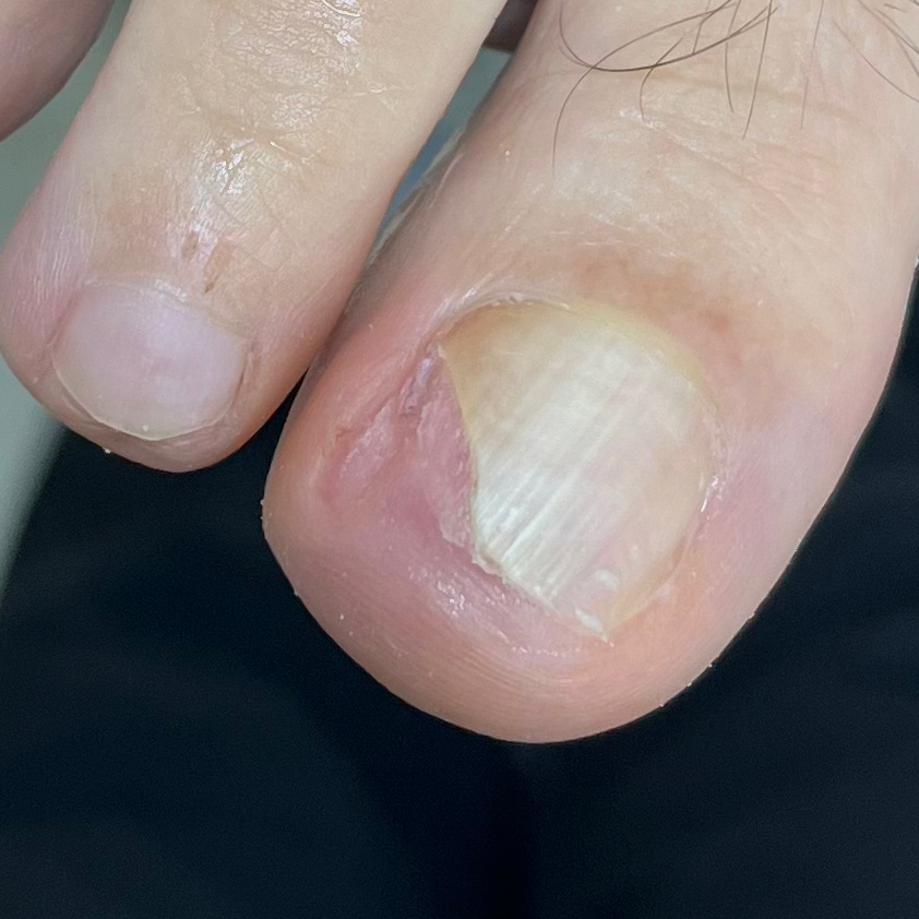 Обработка онихолизиса