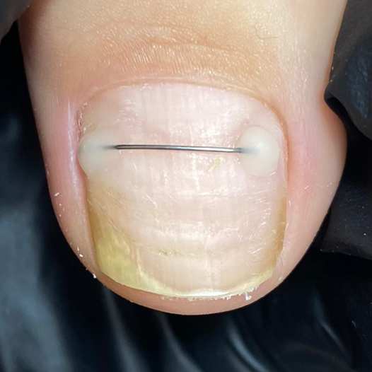 Установка коррекционной системы «Титановая нить»