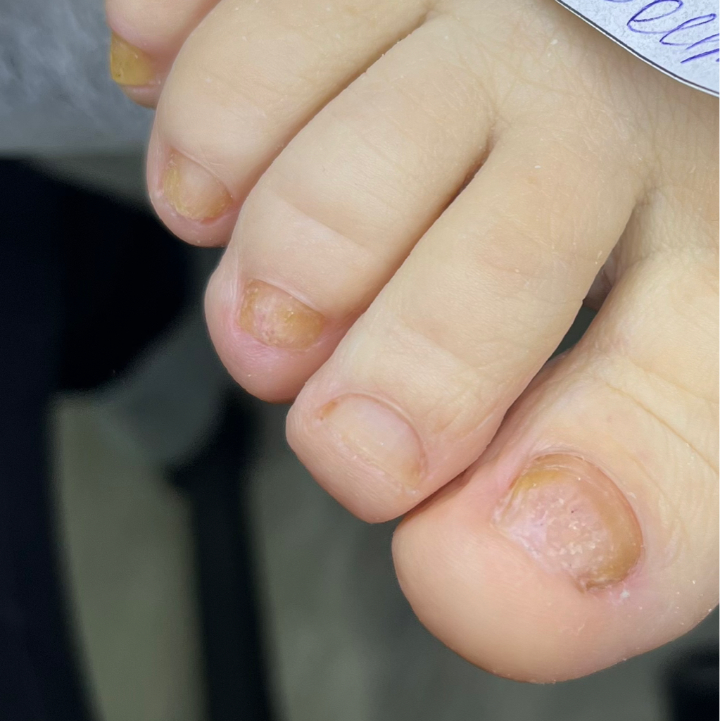 Обработка ногтей с присоединенной грибковой инфекцией