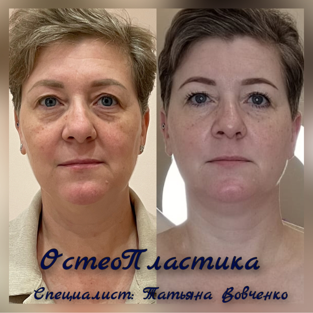 Остеопластика