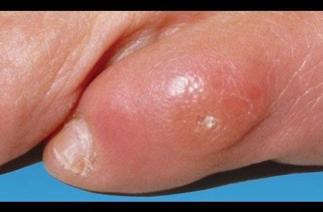 Обработка натоптыша, мозоли