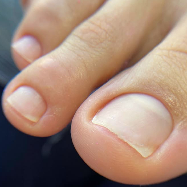 Удаление вросшего ногтя (1 степень)