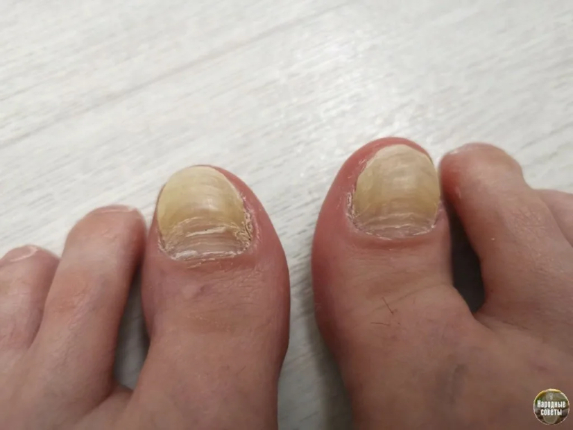 Обработка утолщённых ногтей