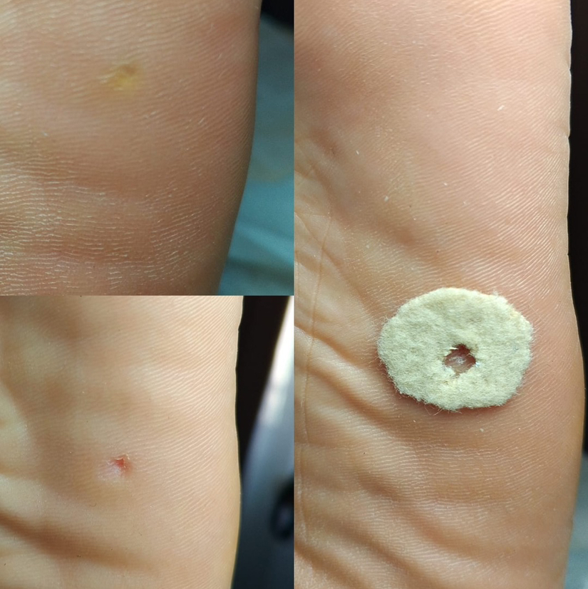 Удаление стержневой мозоли