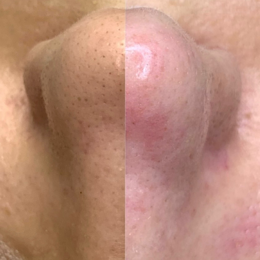 Чистая кожа