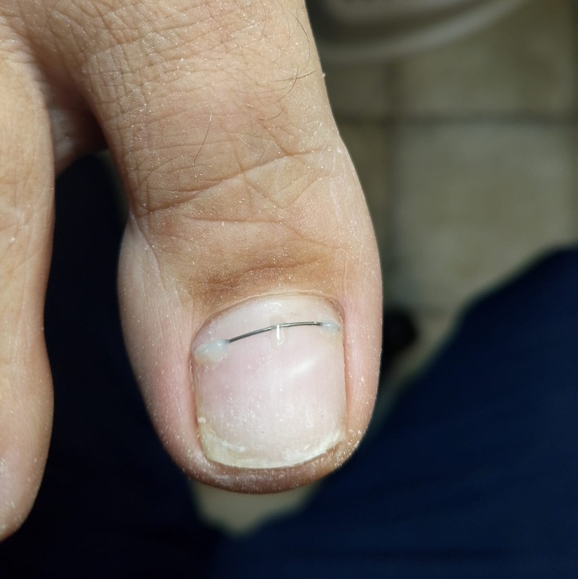 Установка коррекционной системы - титановая нить