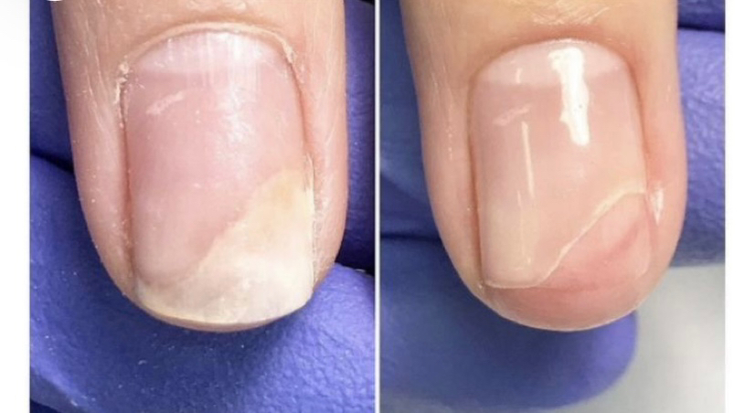 Зачистка онихолизиса