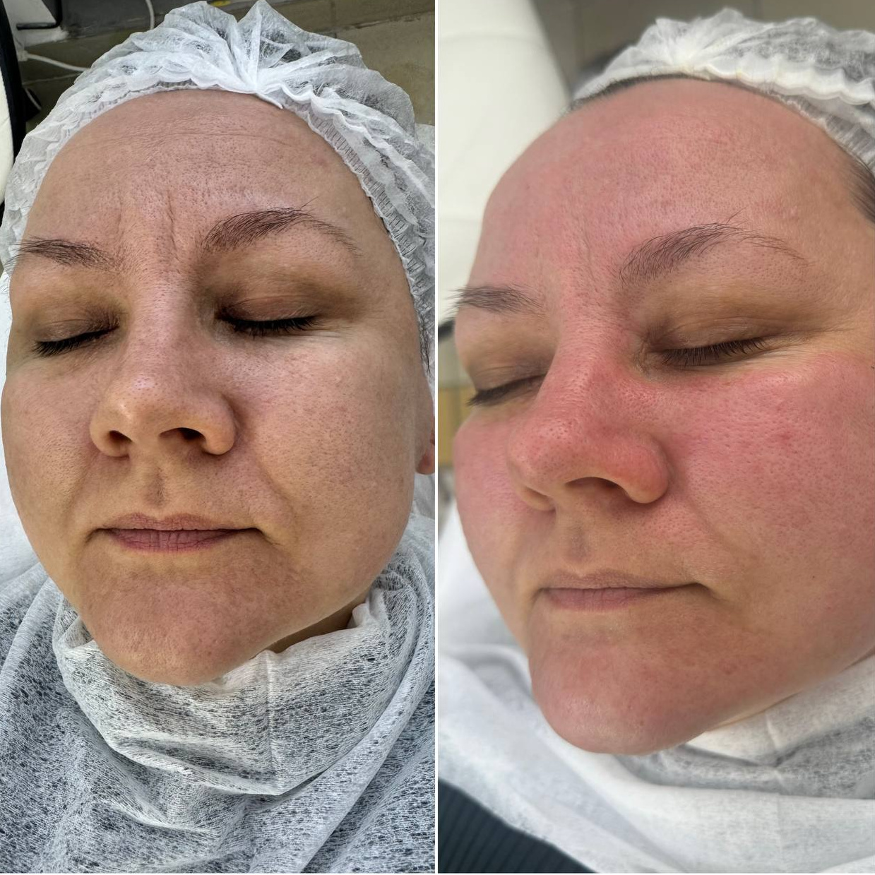 АКЦИЯ Чистка + карбокситерапия