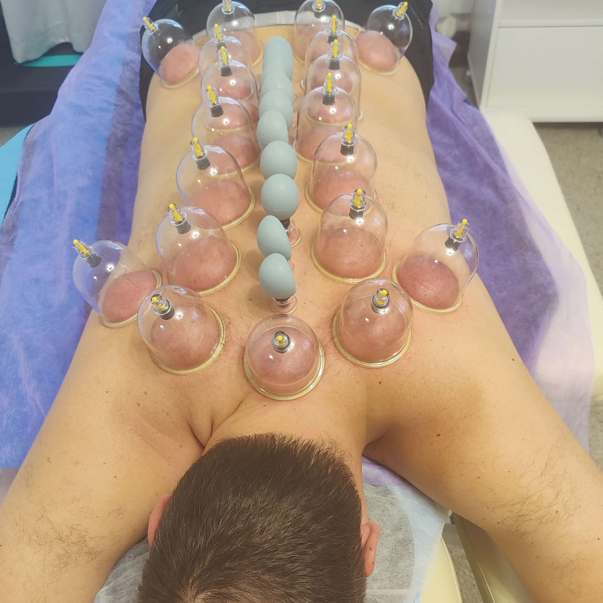 Массаж баночный статический