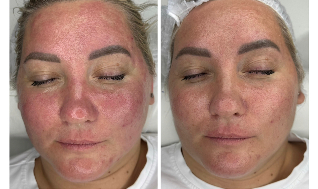 Механическая чистка лица