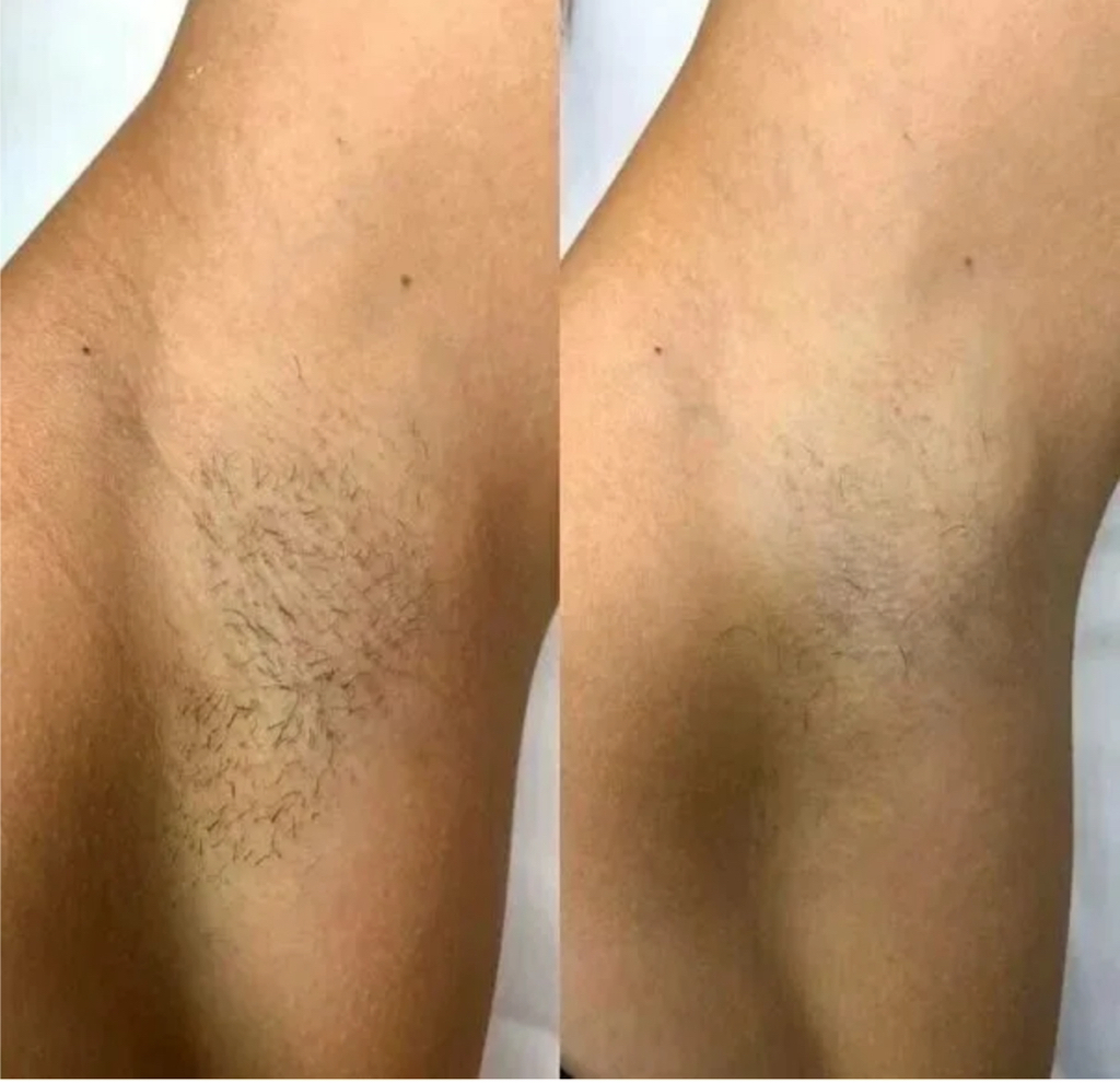 Подмышечные впадины