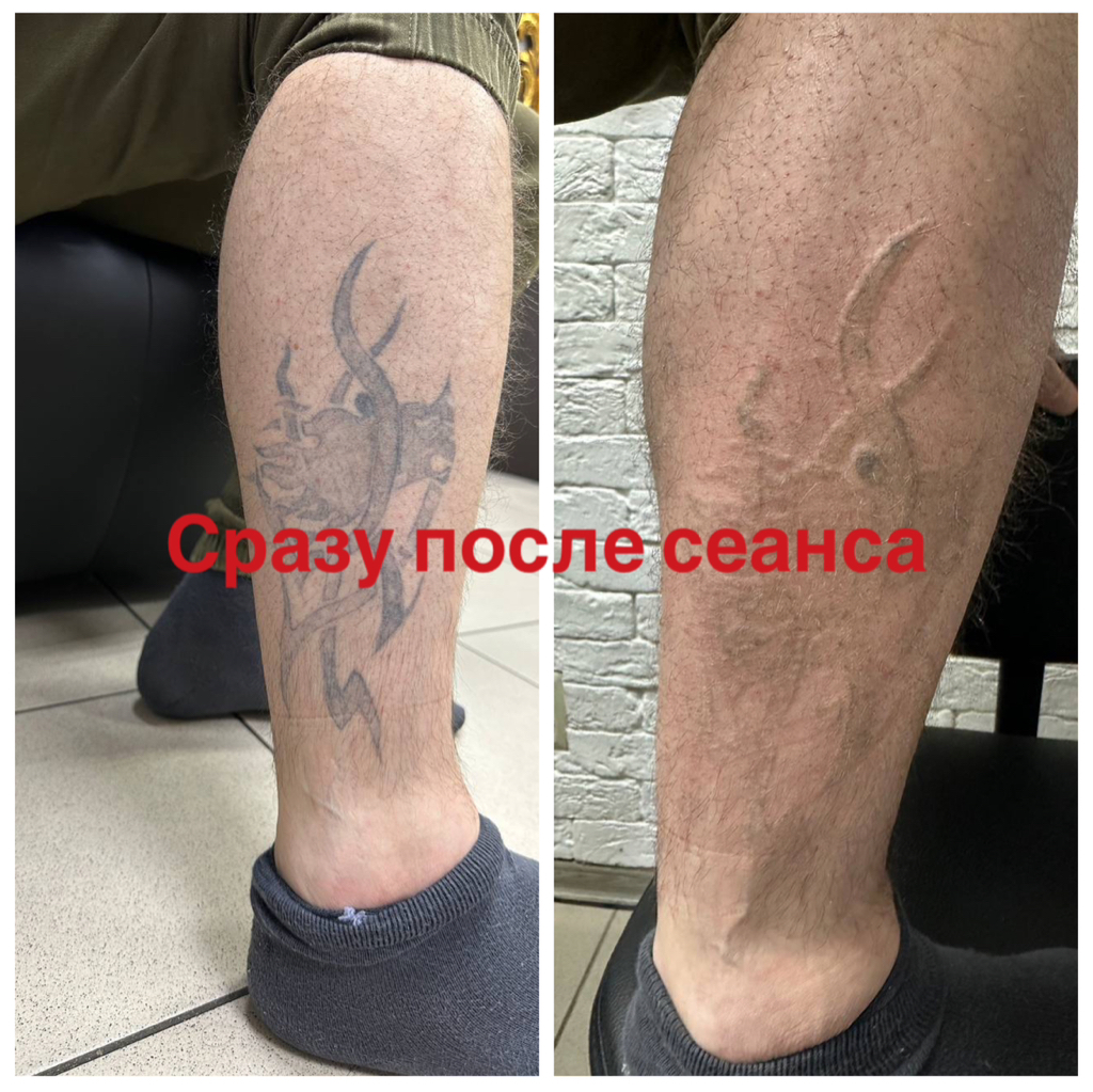 Удаление татуировок S