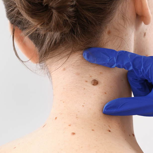 Удаление родинки  (CO2 лазер) + исследование