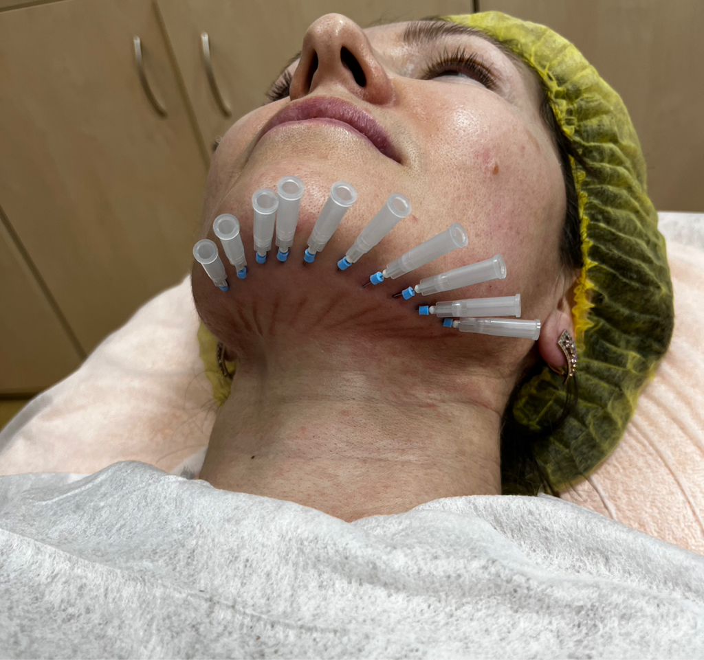 Тредлифтинг мезонитями