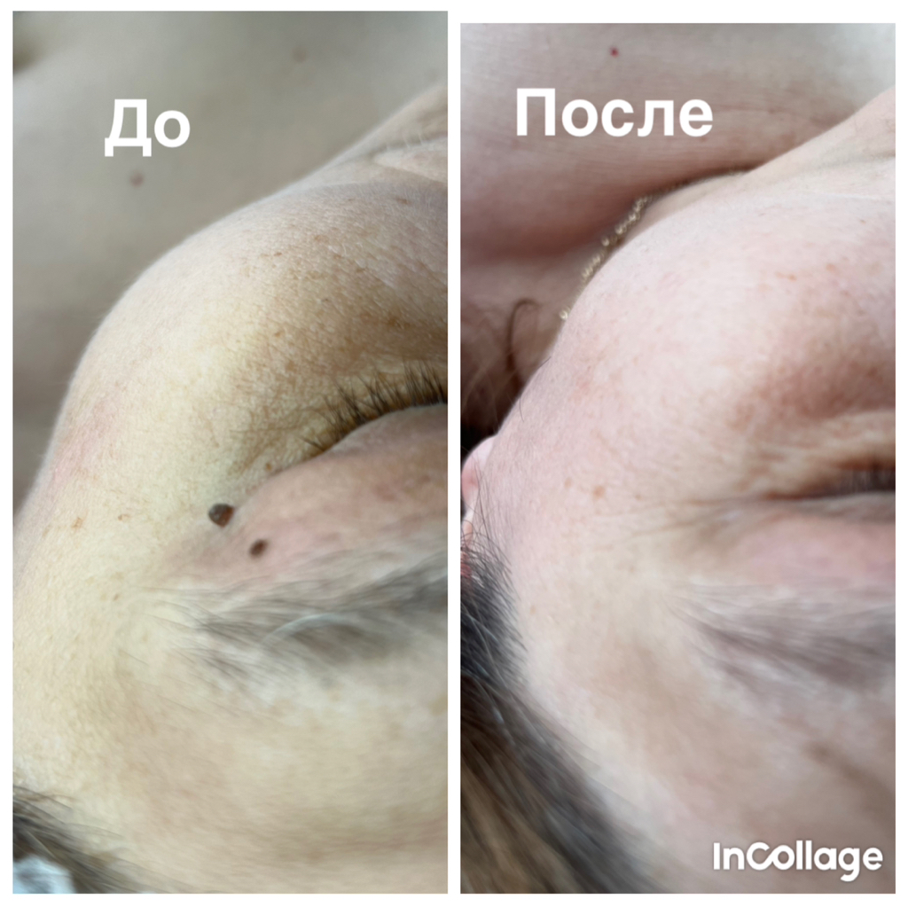 Удаление папилломы