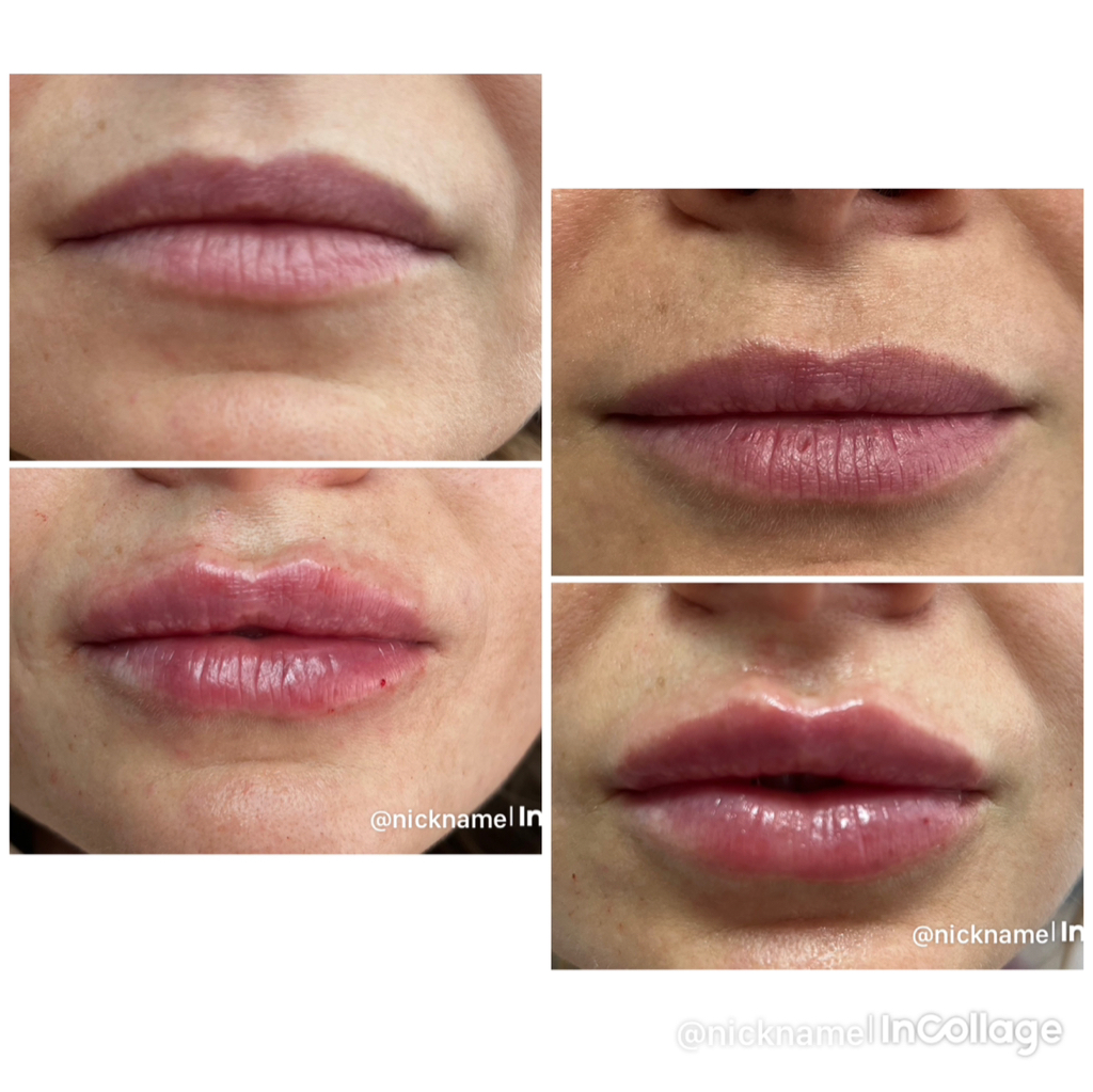 Контурная пластика -губы