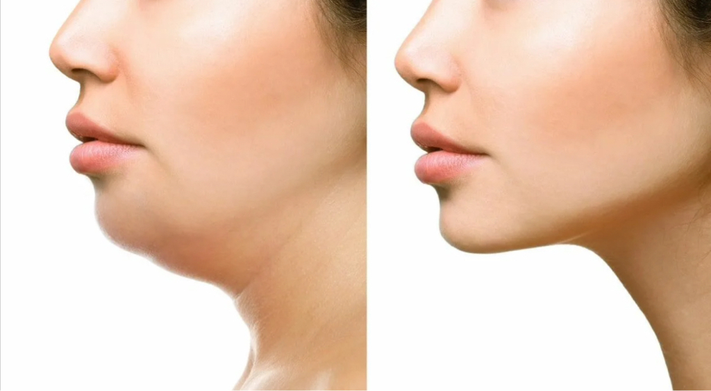 Липолиз лица