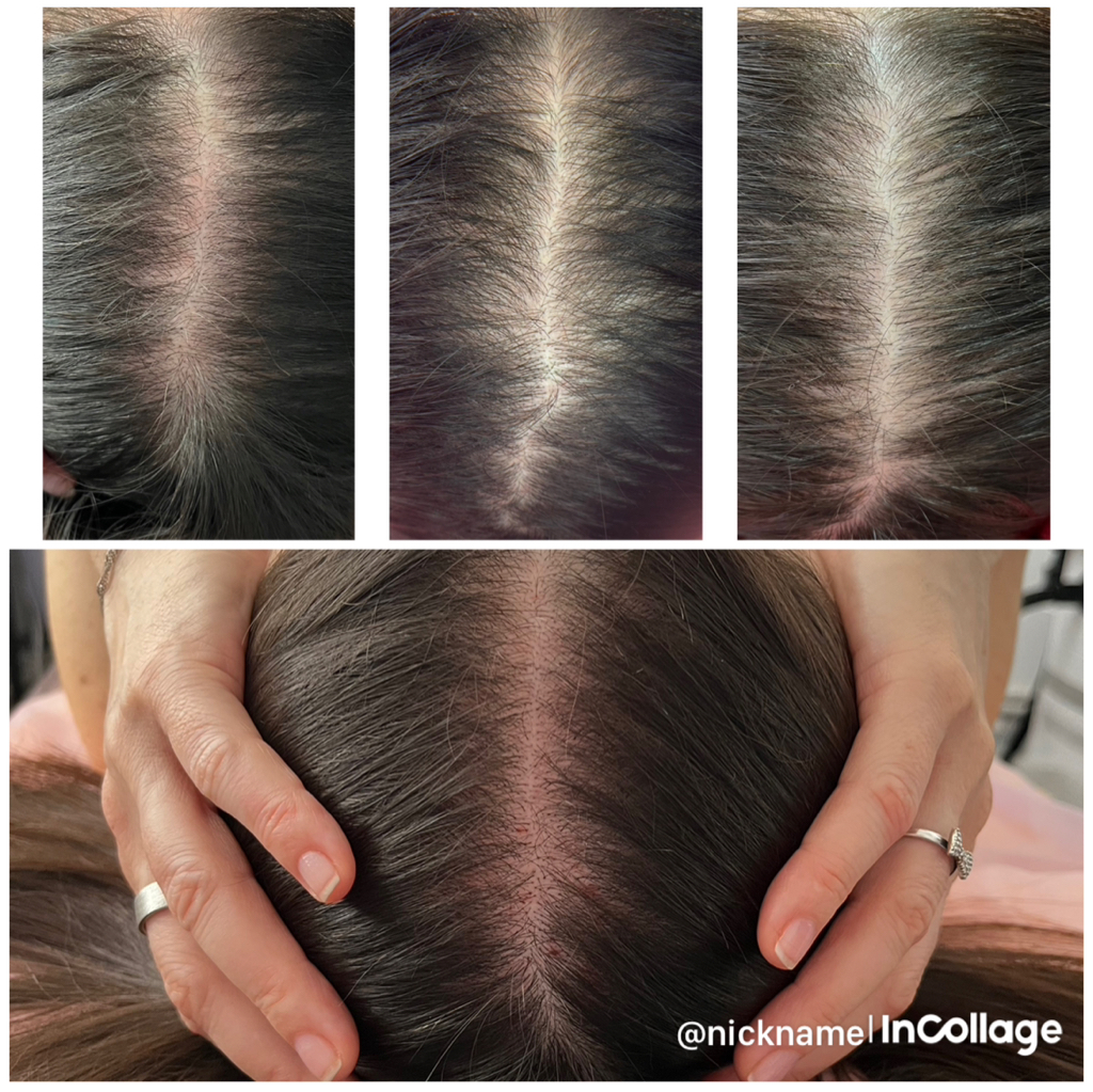 Мезотерапия волосистой части головы